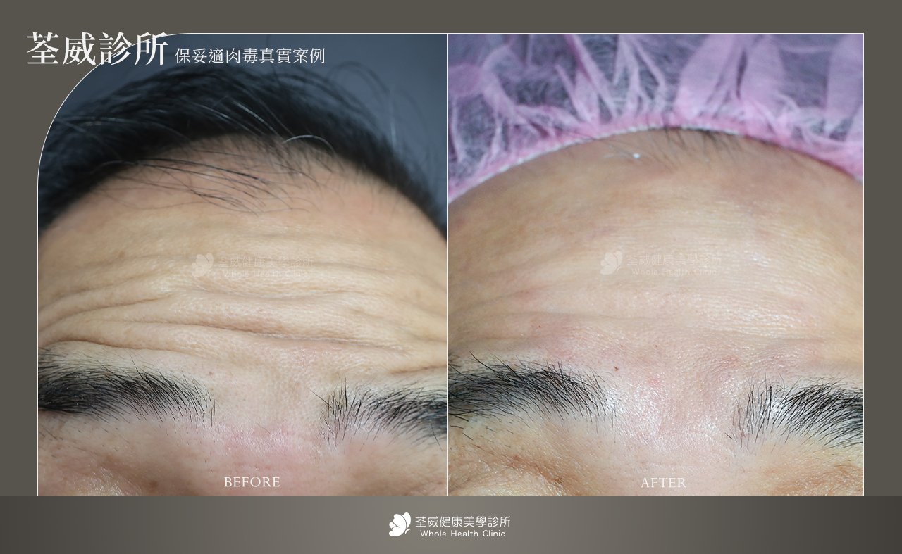 撫平動態紋路 (除皺) 撫平動態紋路 (除皺)