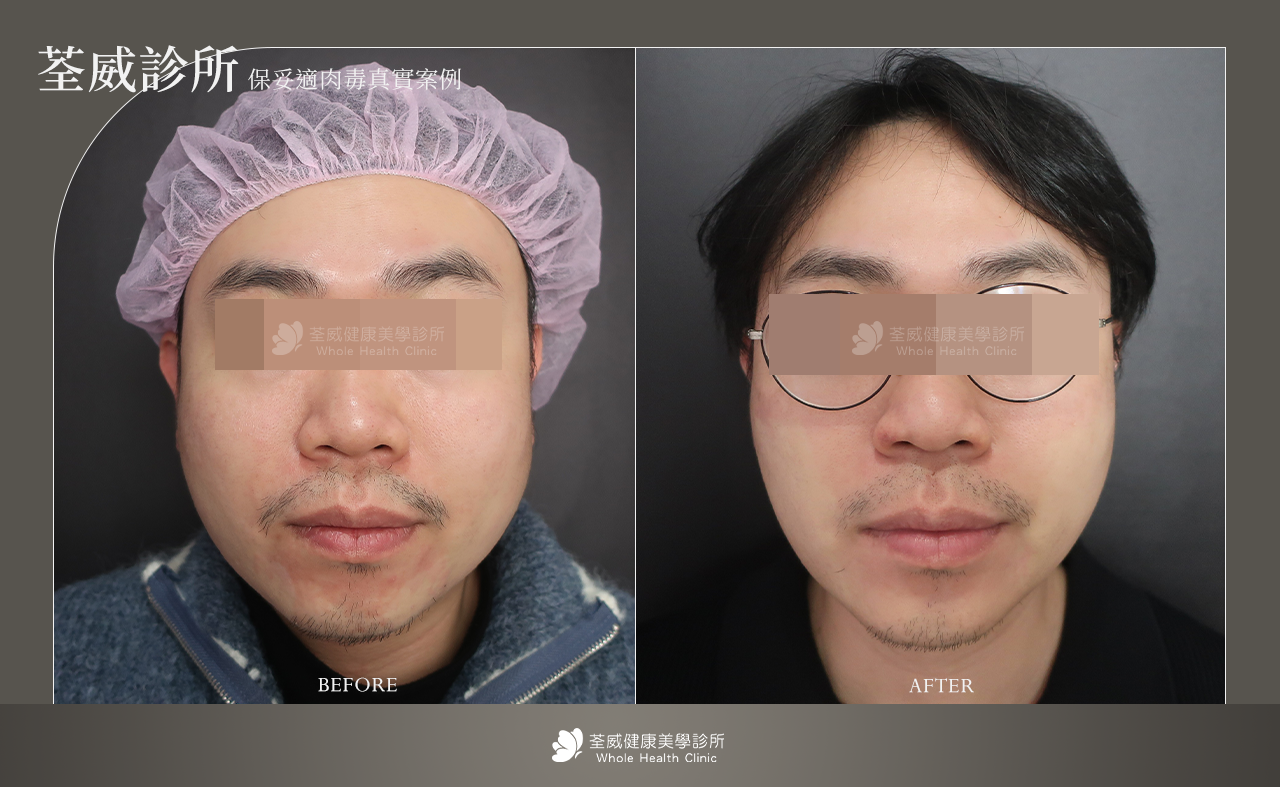 雕塑臉部輪廓 (瘦小臉) 雕塑臉部輪廓 (瘦小臉)